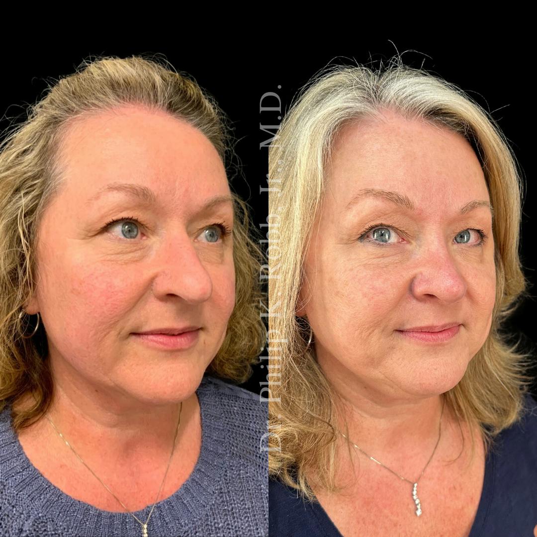 Nose Before & After Gallery - Patient 189960490 - Image 3