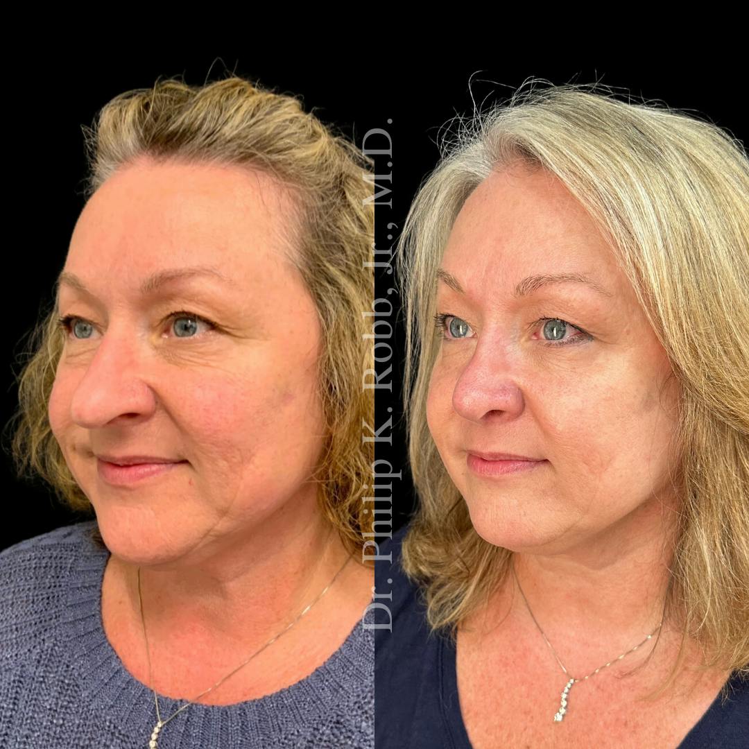 Nose Before & After Gallery - Patient 189960490 - Image 4