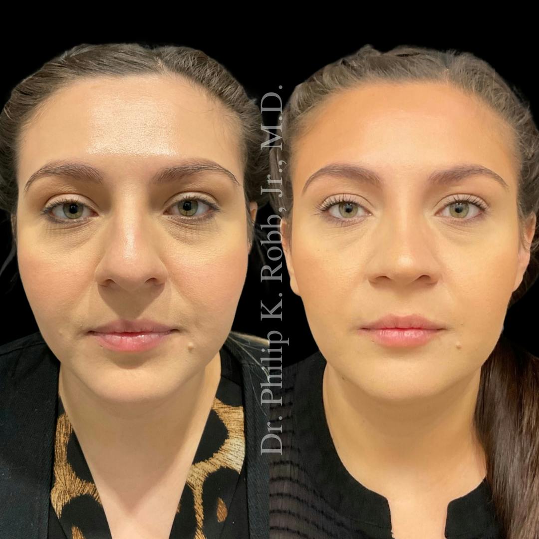 Nose Before & After Gallery - Patient 189960516 - Image 2