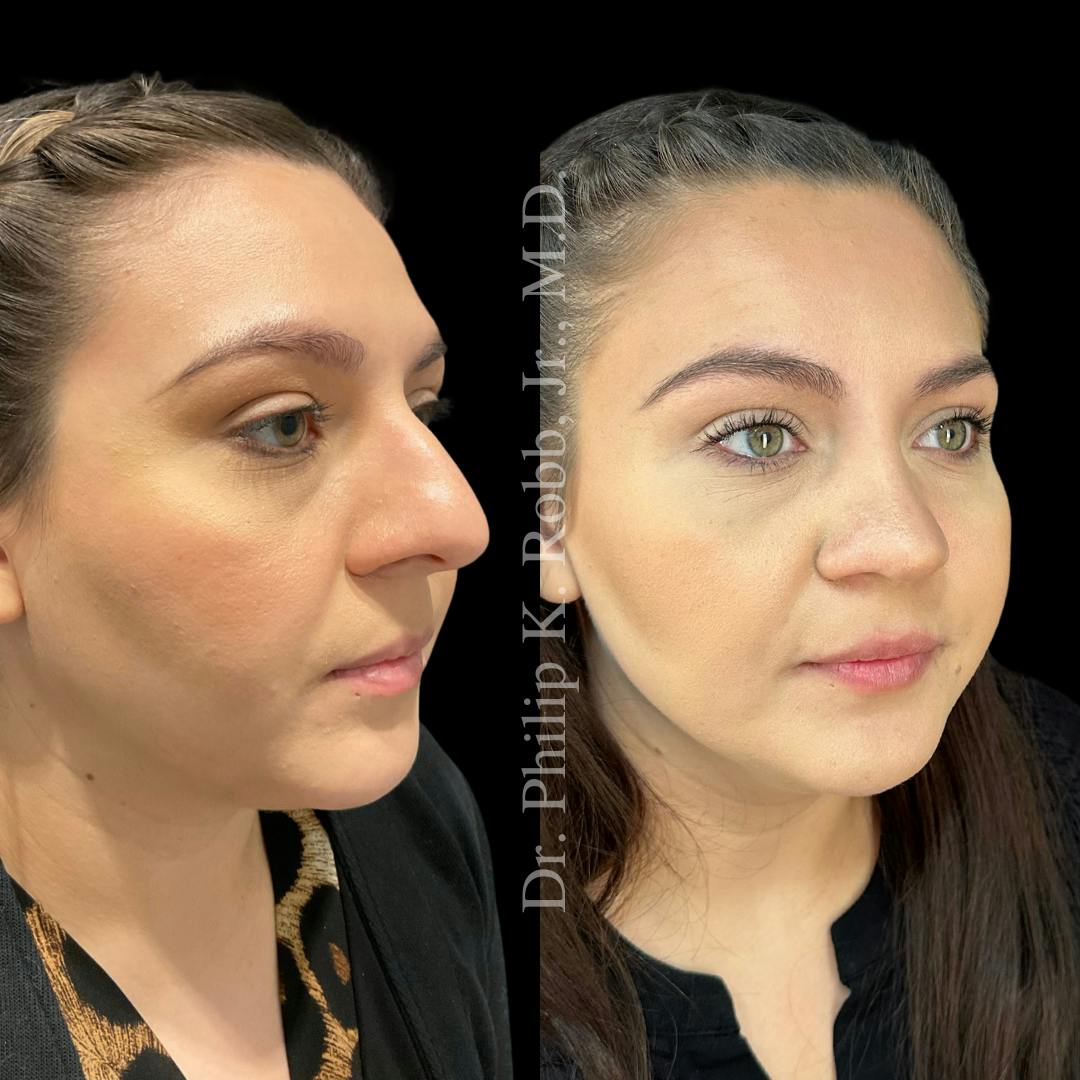 Nose Before & After Gallery - Patient 189960516 - Image 3