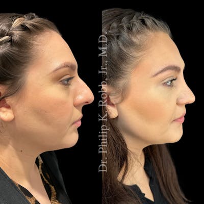 Nose Before & After Gallery - Patient 189960516 - Image 1