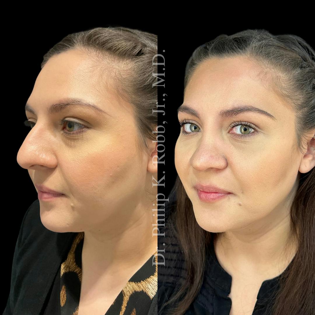 Nose Before & After Gallery - Patient 189960516 - Image 4