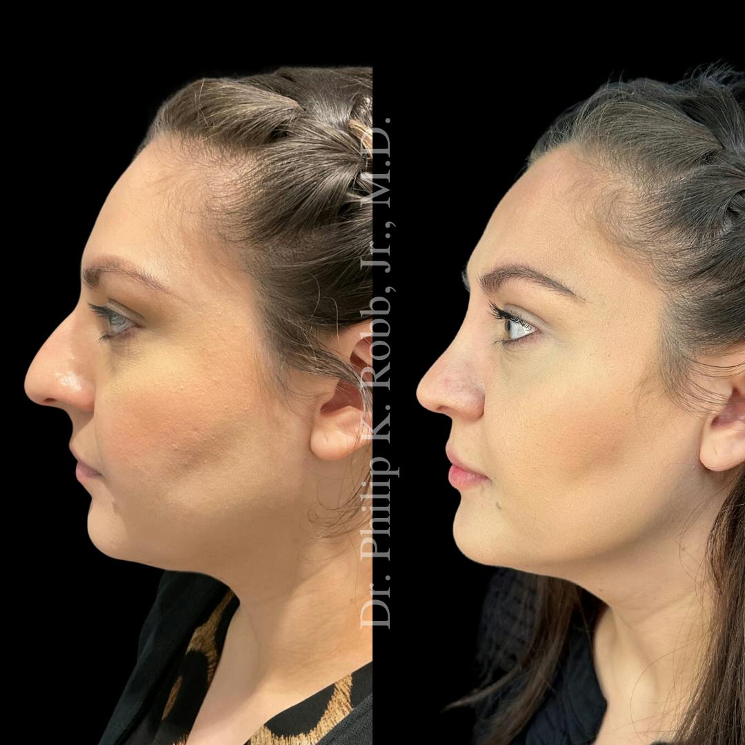 Nose Before & After Gallery - Patient 189960516 - Image 5