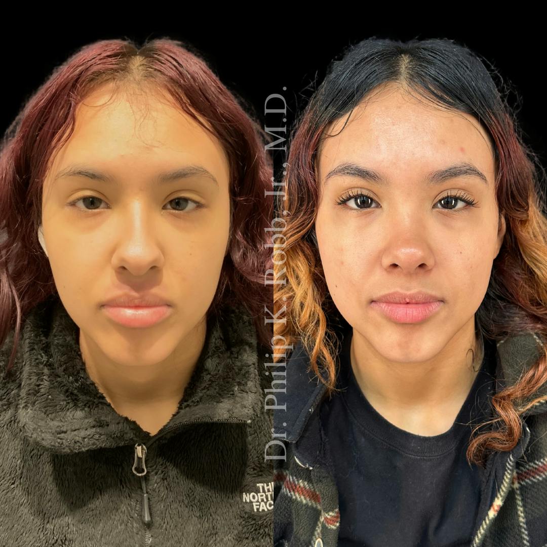 Nose Before & After Gallery - Patient 189960529 - Image 2