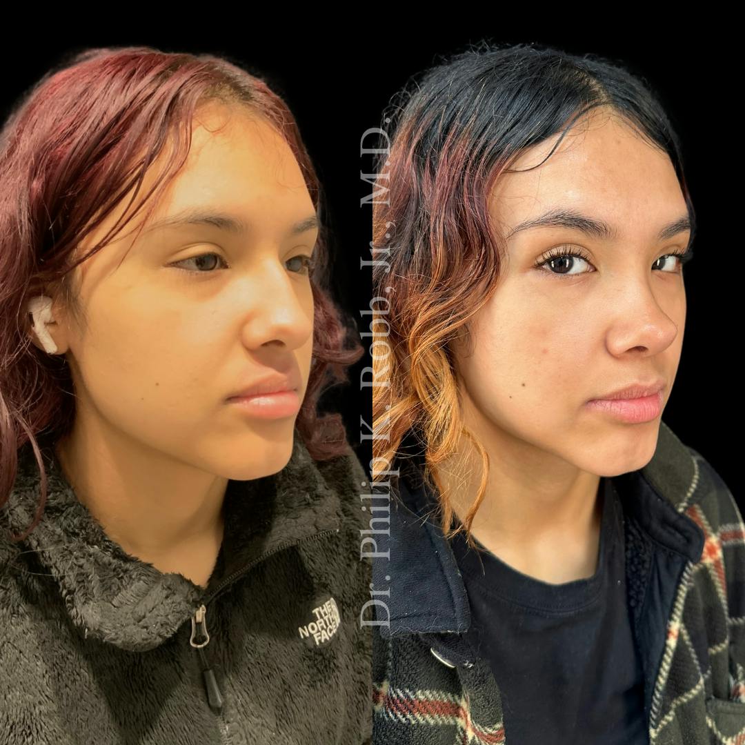 Nose Before & After Gallery - Patient 189960529 - Image 3
