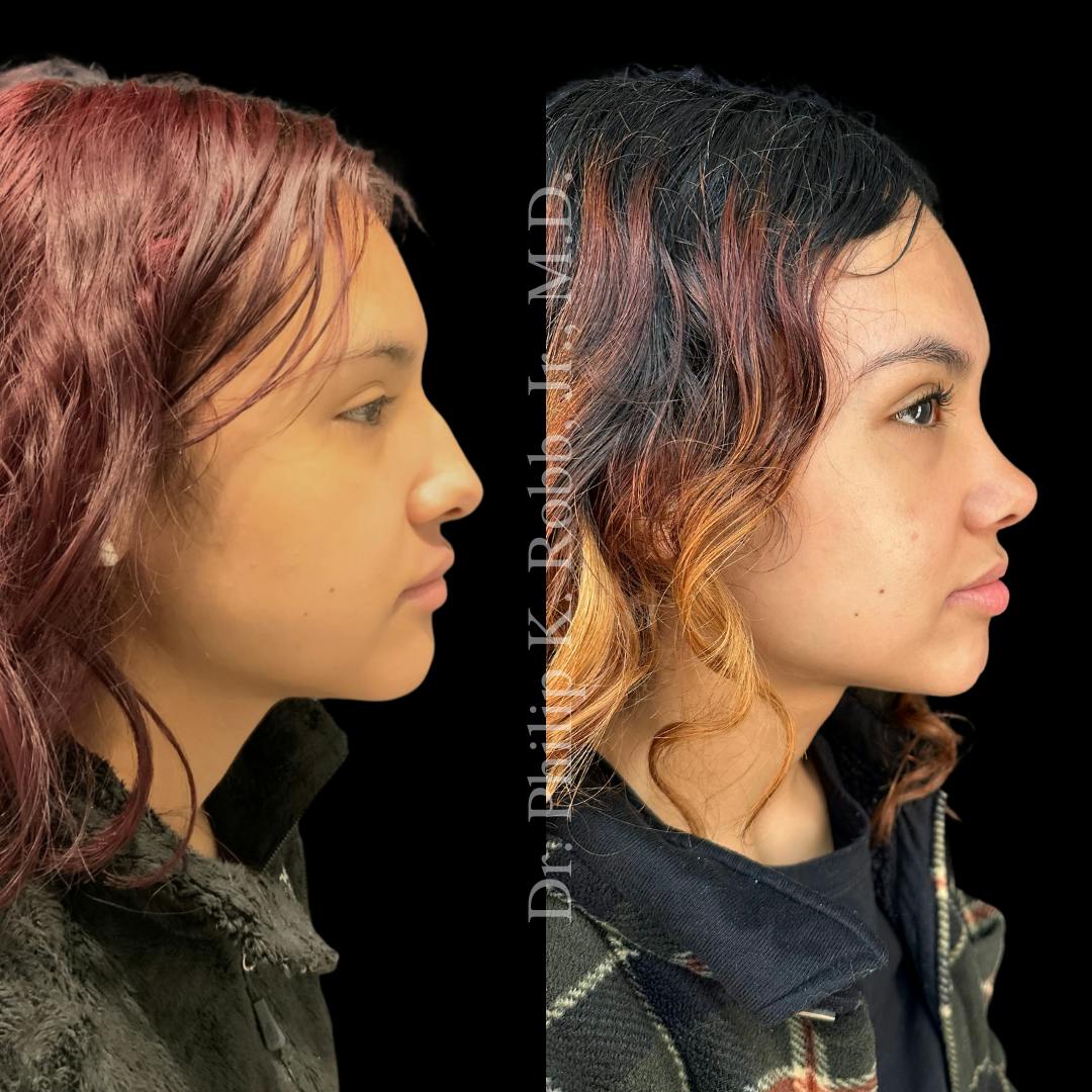 Nose Before & After Gallery - Patient 189960529 - Image 1