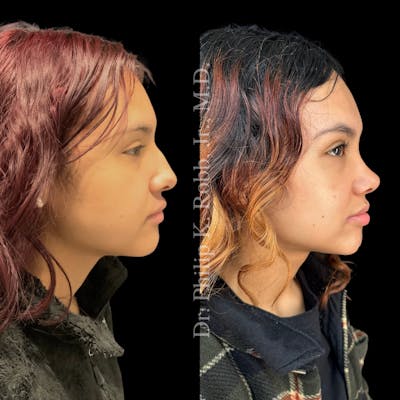 Nose Before & After Gallery - Patient 189960529 - Image 1