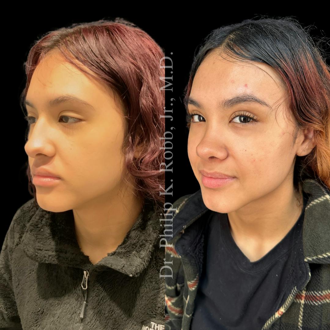 Nose Before & After Gallery - Patient 189960529 - Image 4