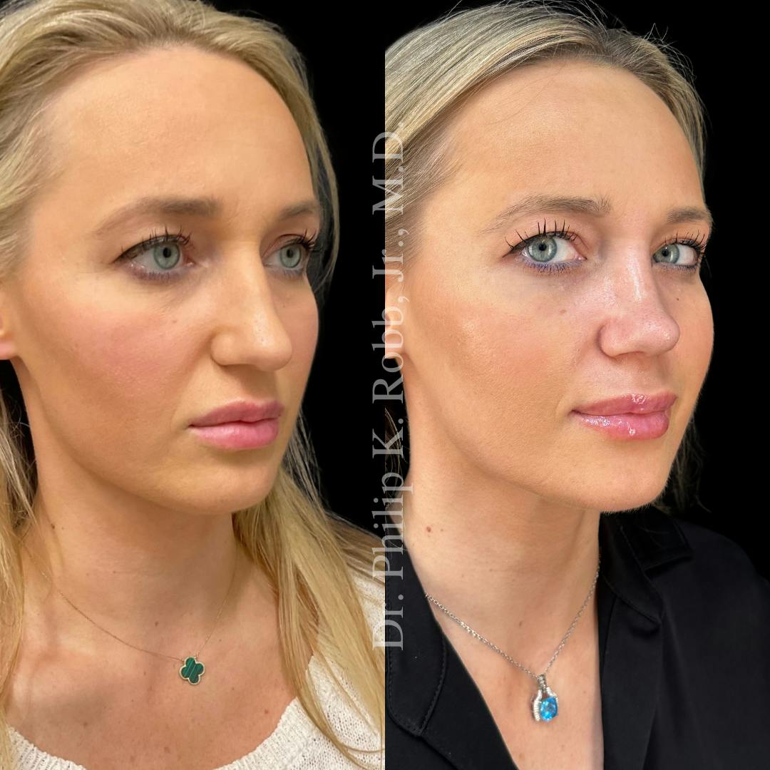 Nose Before & After Gallery - Patient 189960532 - Image 3
