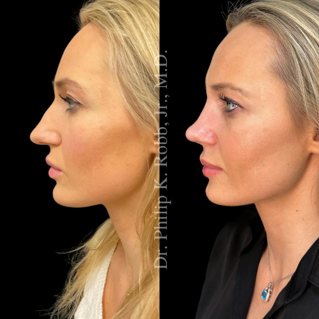 Nose Before & After Gallery - Patient 189960532 - Image 5