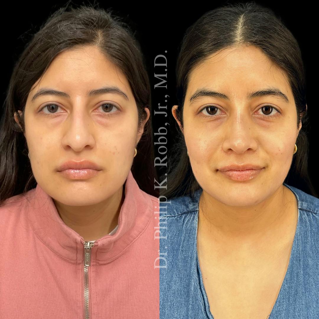 Nose Before & After Gallery - Patient 189960547 - Image 2
