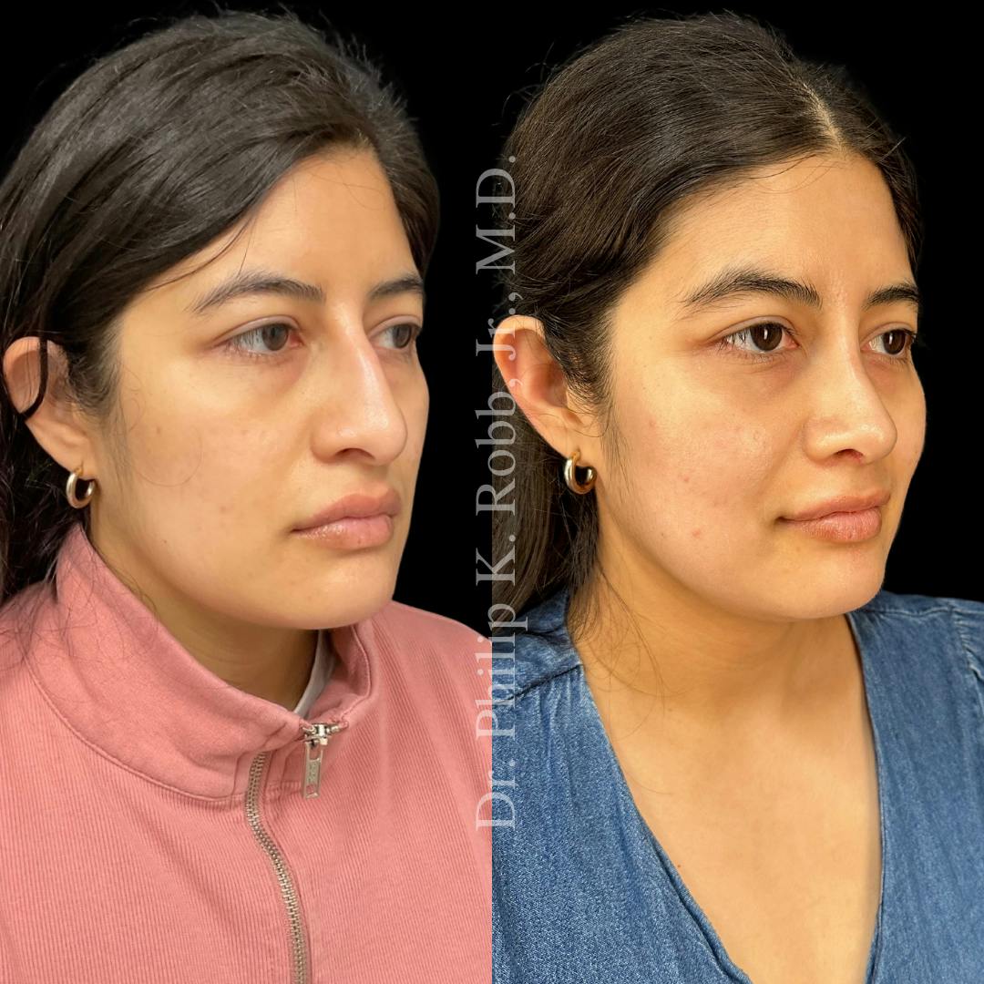 Nose Before & After Gallery - Patient 189960547 - Image 3