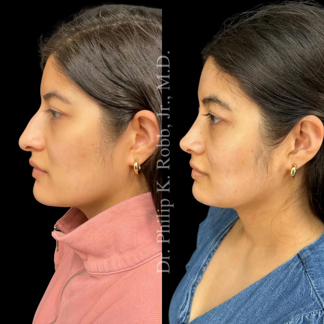 Nose Before & After Gallery - Patient 189960547 - Image 5
