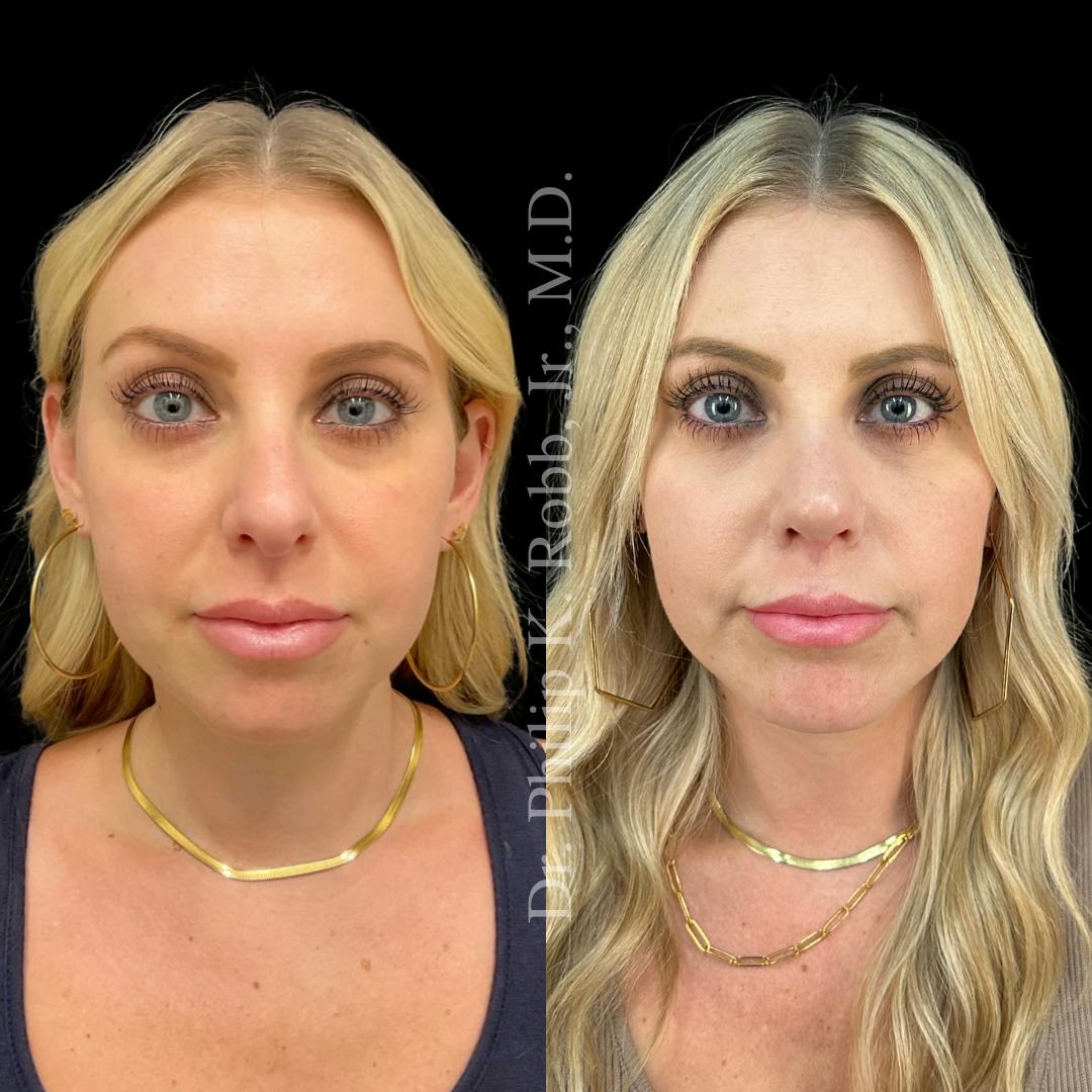 Nose Before & After Gallery - Patient 189960595 - Image 2