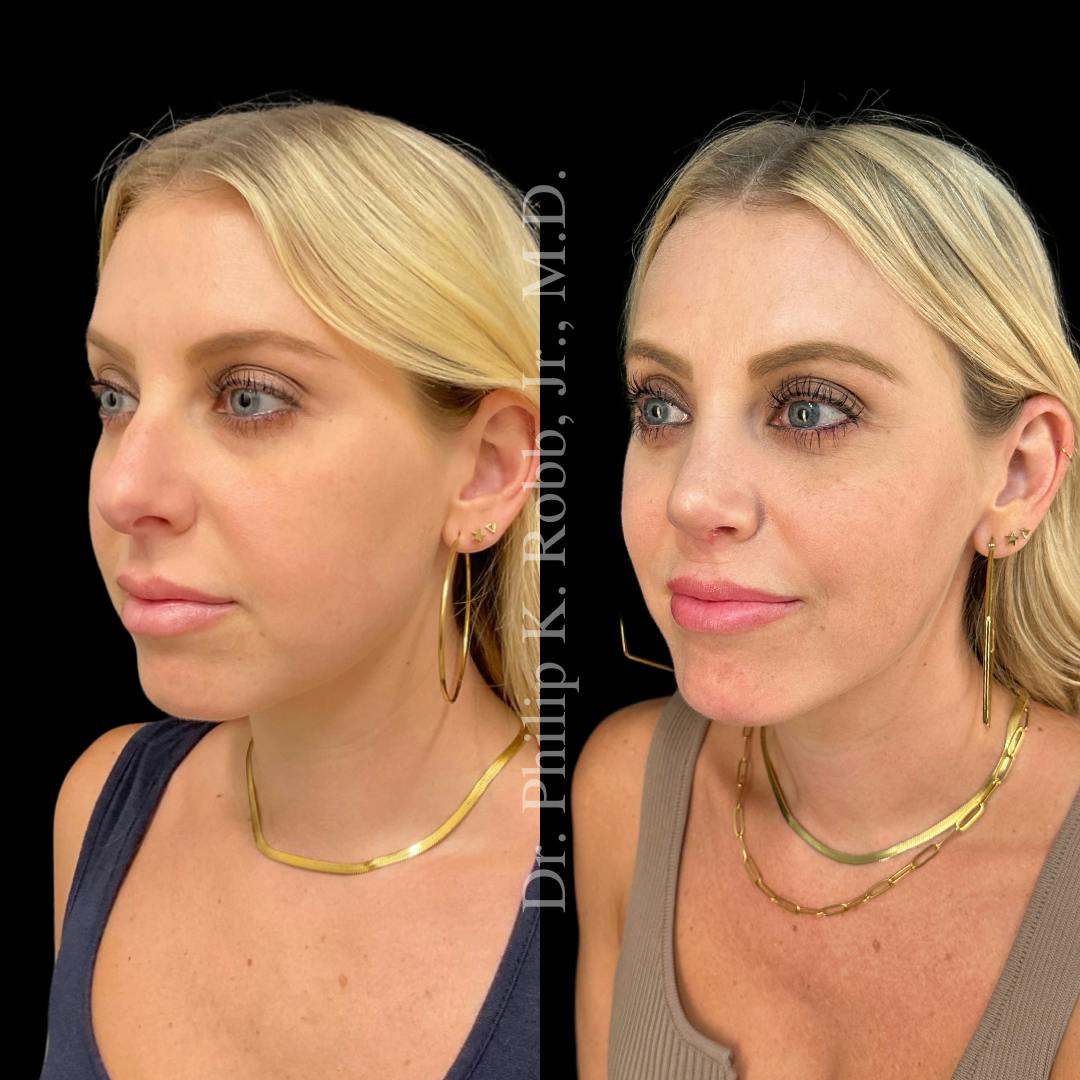 Nose Before & After Gallery - Patient 189960595 - Image 4
