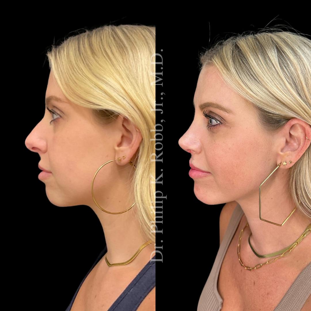 Nose Before & After Gallery - Patient 189960595 - Image 5