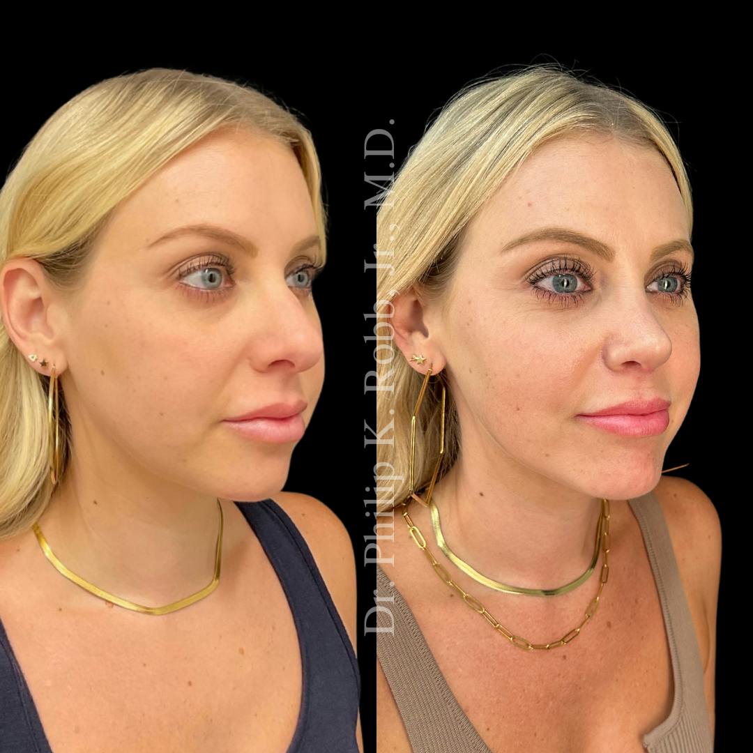 Nose Before & After Gallery - Patient 189960595 - Image 3