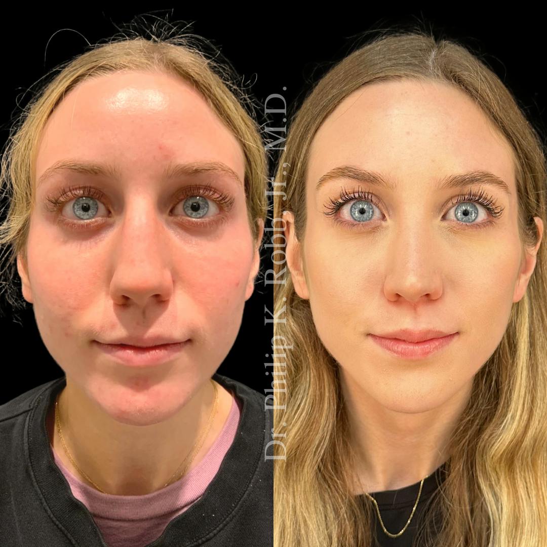 Nose Before & After Gallery - Patient 189960641 - Image 2
