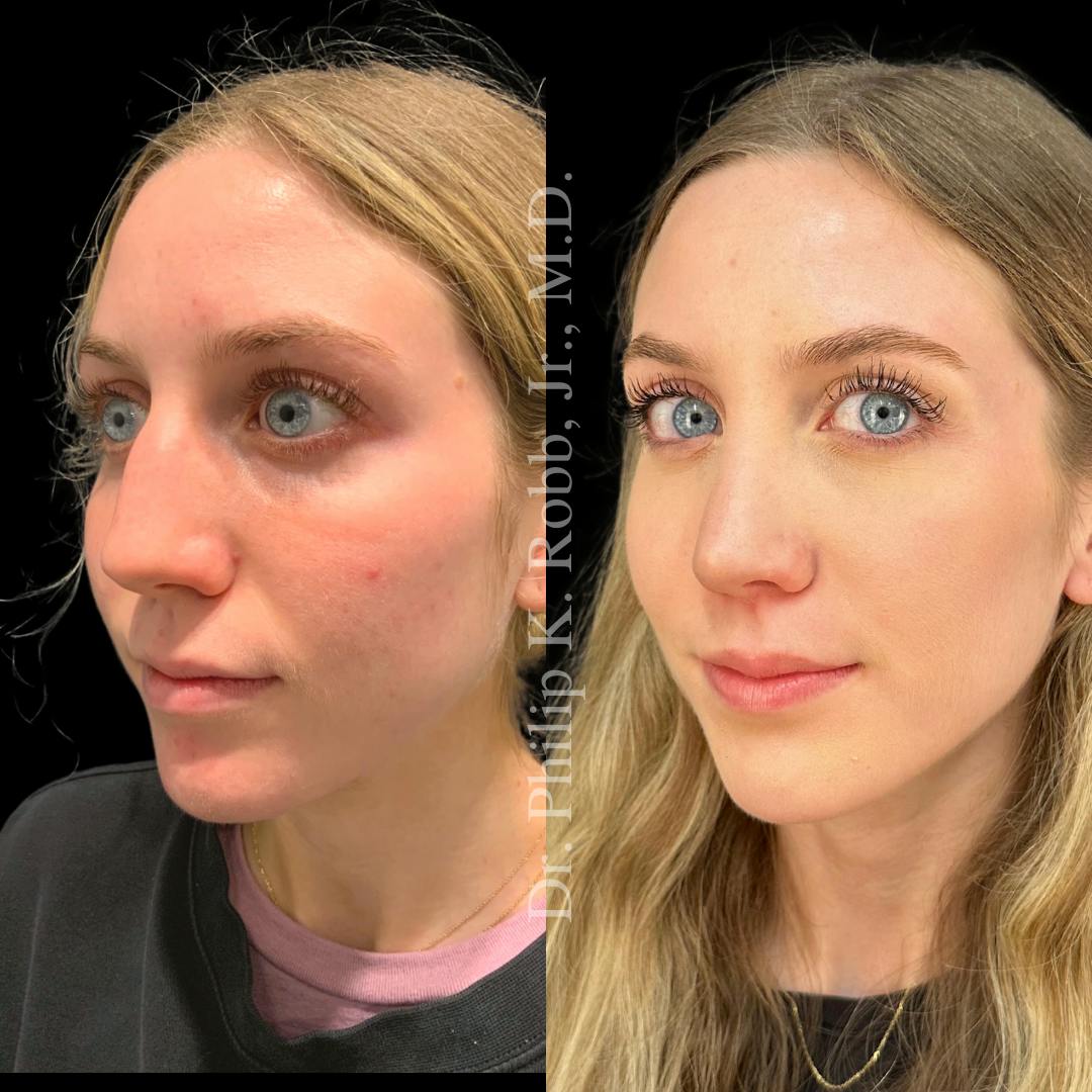 Nose Before & After Gallery - Patient 189960641 - Image 3