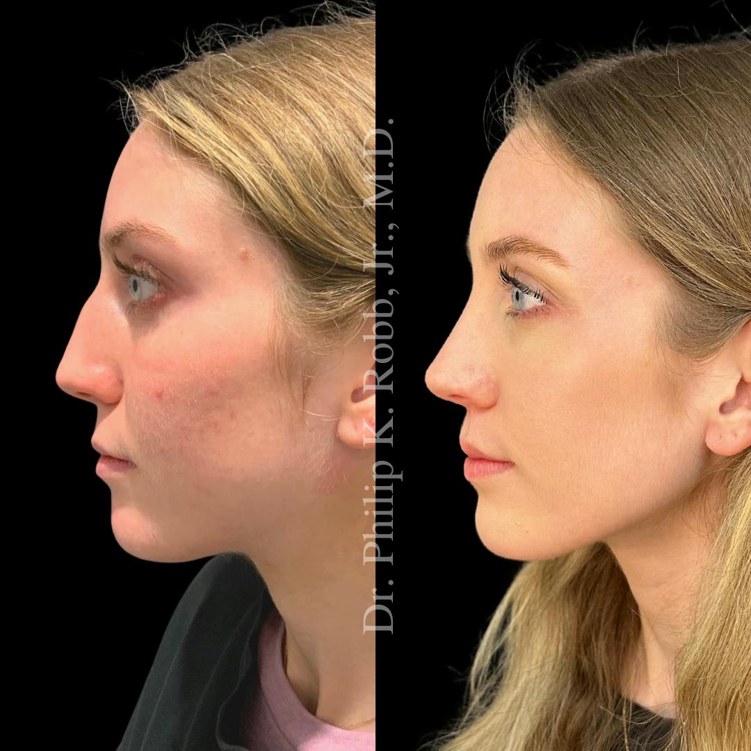 Nose Before & After Gallery - Patient 189960641 - Image 4