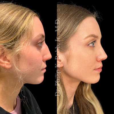 Nose Before & After Gallery - Patient 189960641 - Image 1