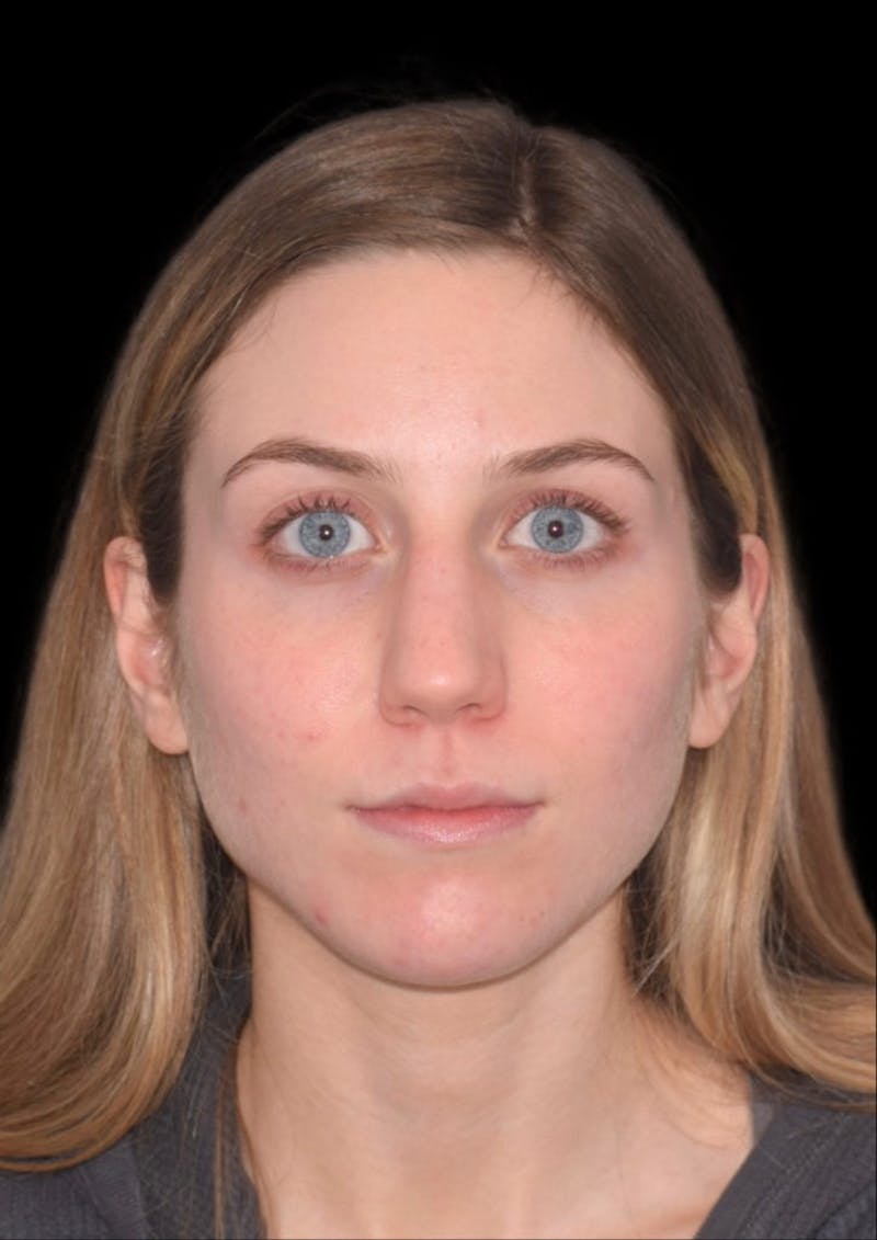 Nose Before & After Gallery - Patient 189960656 - Image 3