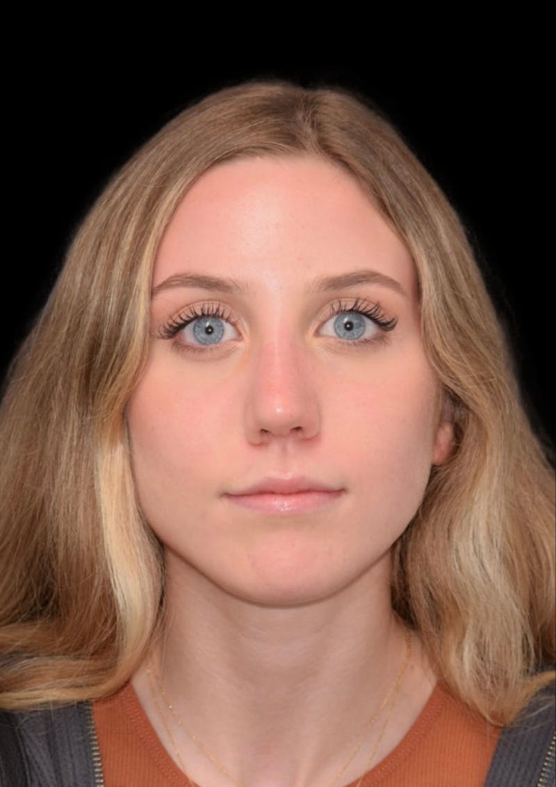 Nose Before & After Gallery - Patient 189960656 - Image 4