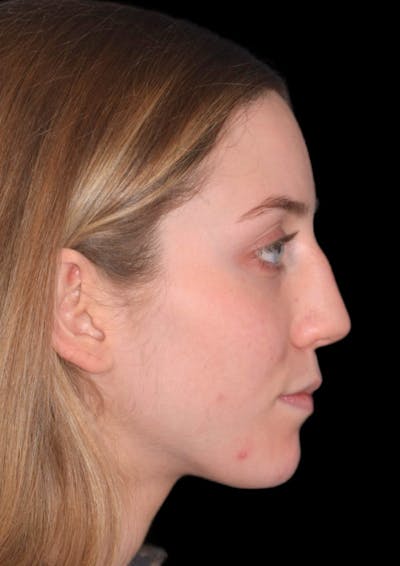 Nose Before & After Gallery - Patient 189960656 - Image 1