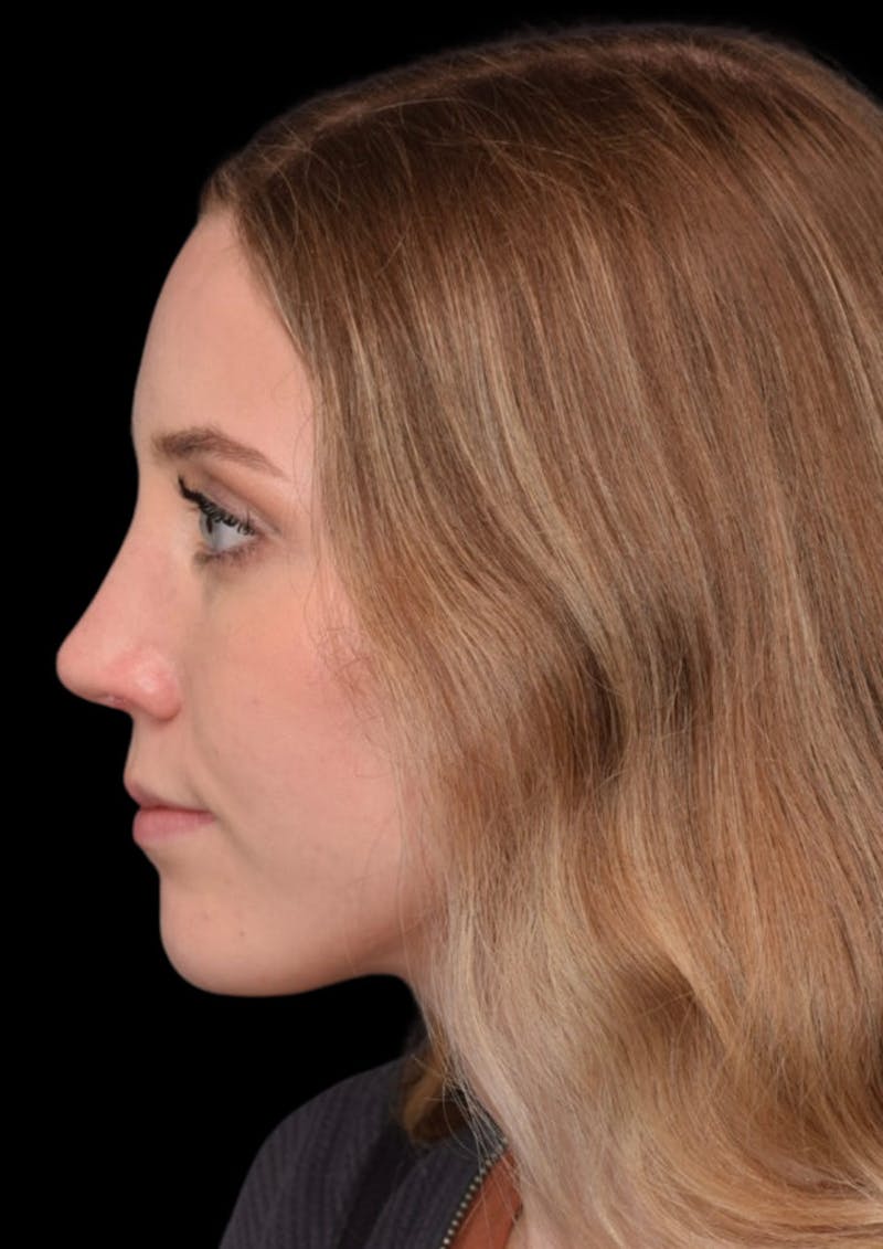 Nose Before & After Gallery - Patient 189960656 - Image 10