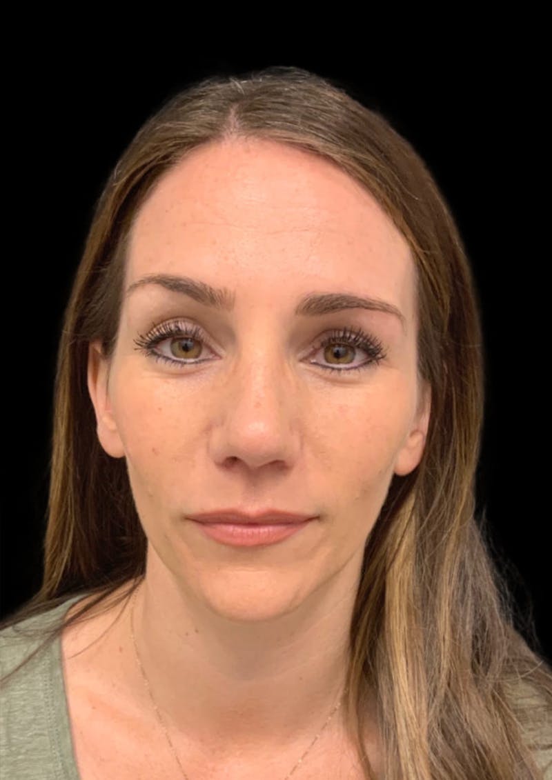 Nose Before & After Gallery - Patient 189960661 - Image 4
