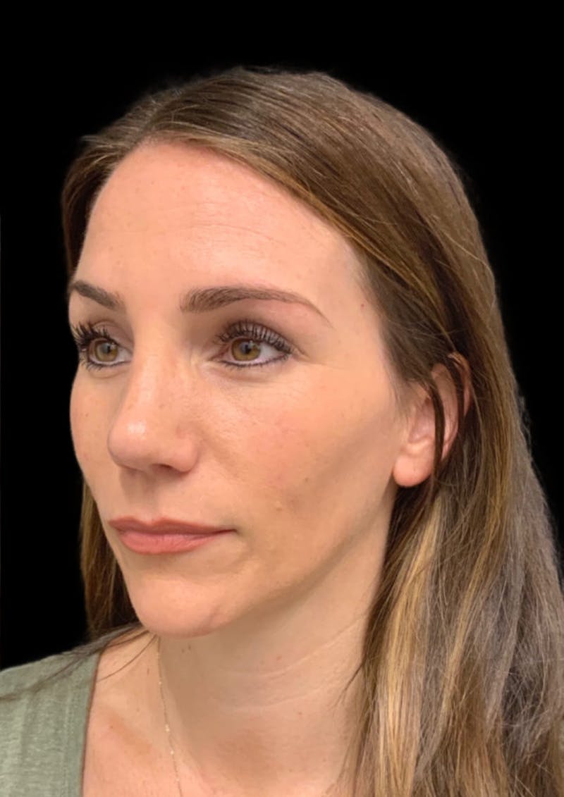 Nose Before & After Gallery - Patient 189960661 - Image 8