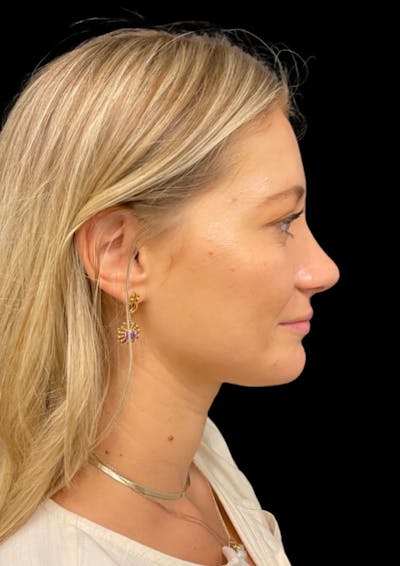 Nose Before & After Gallery - Patient 189960666 - Image 2