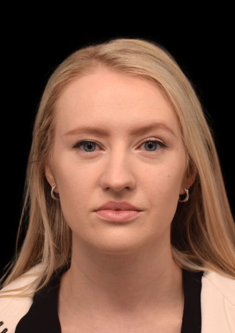 Nose Before & After Gallery - Patient 189960669 - Image 3