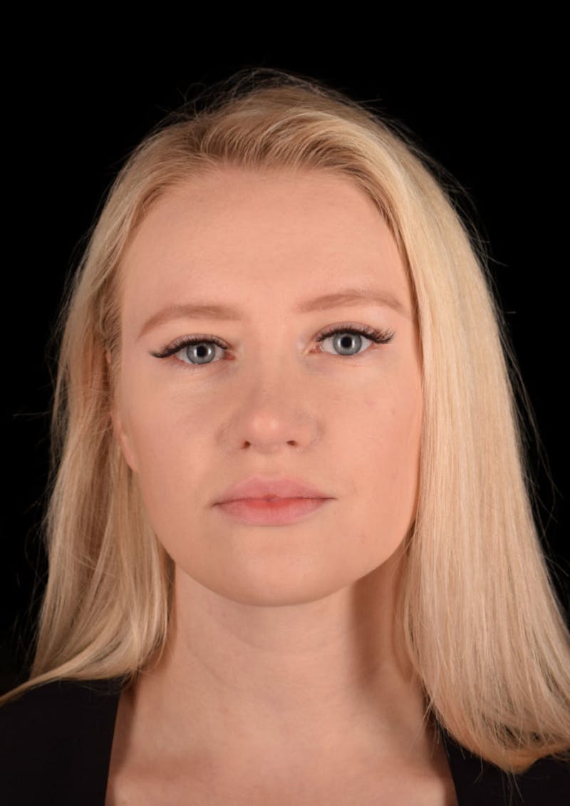 Nose Before & After Gallery - Patient 189960669 - Image 4