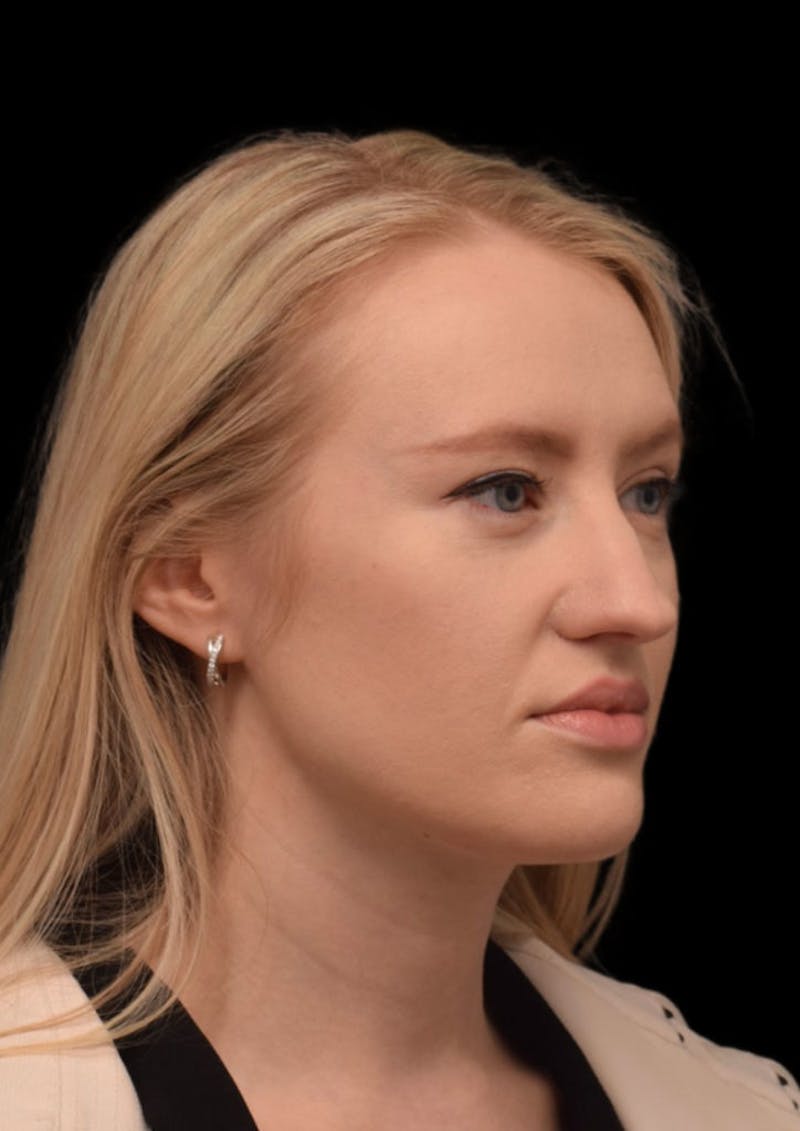 Nose Before & After Gallery - Patient 189960669 - Image 5