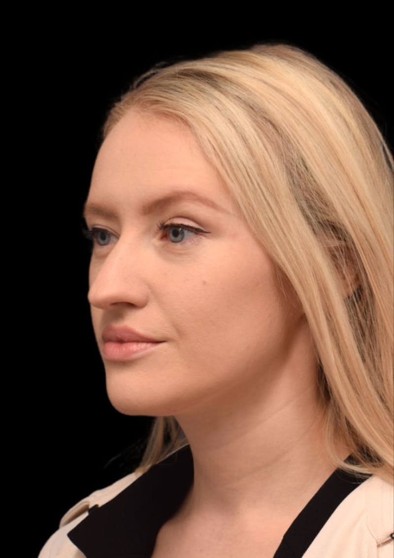 Nose Before & After Gallery - Patient 189960669 - Image 7