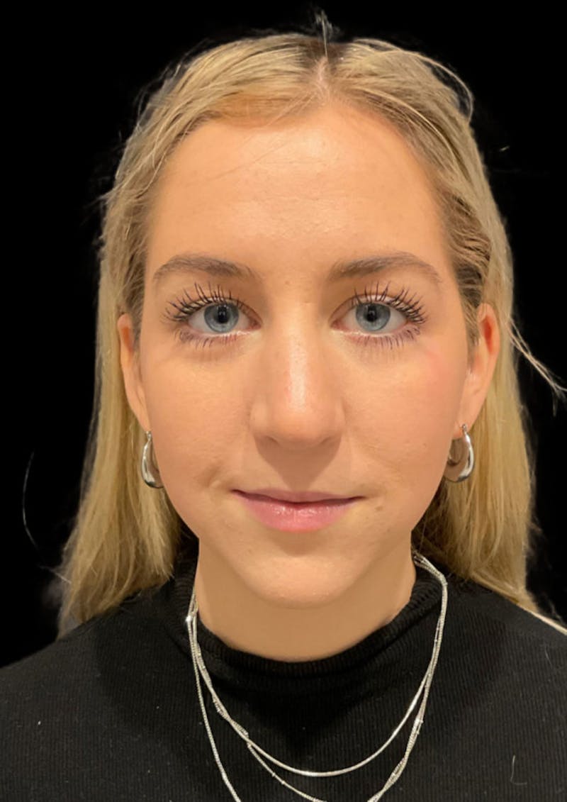 Nose Before & After Gallery - Patient 189960672 - Image 3