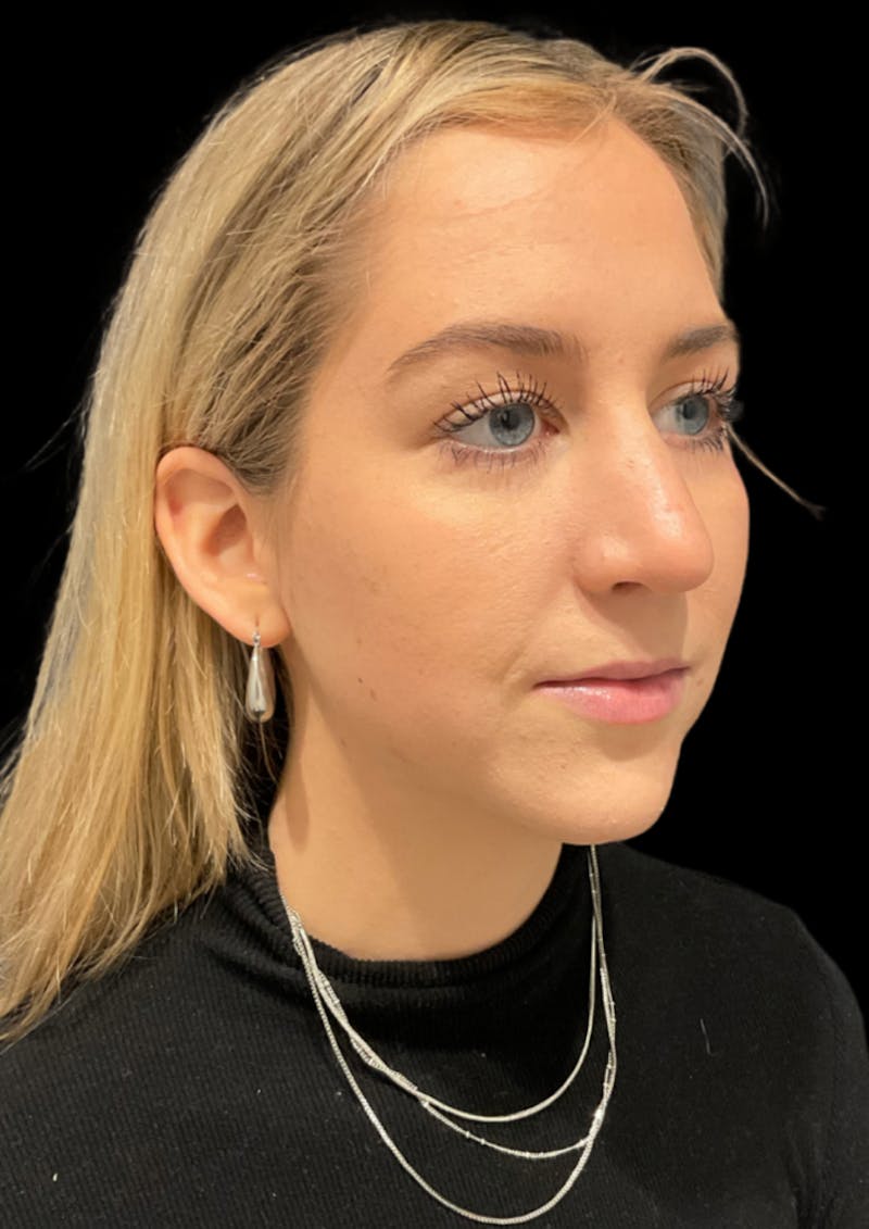 Nose Before & After Gallery - Patient 189960672 - Image 5