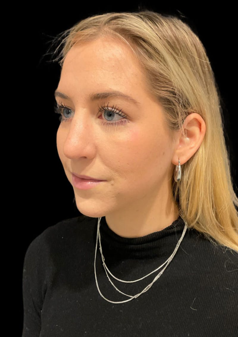 Nose Before & After Gallery - Patient 189960672 - Image 7