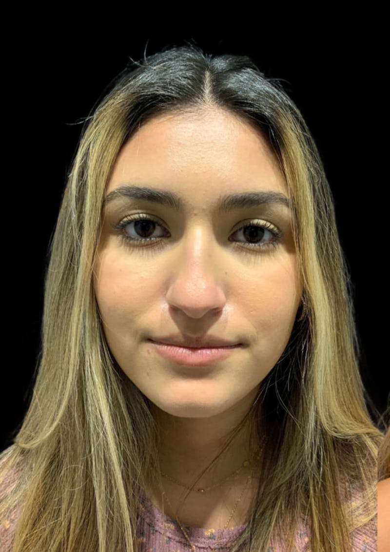 Nose Before & After Gallery - Patient 189960712 - Image 3