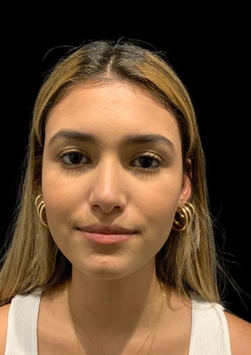 Nose Before & After Gallery - Patient 189960712 - Image 4