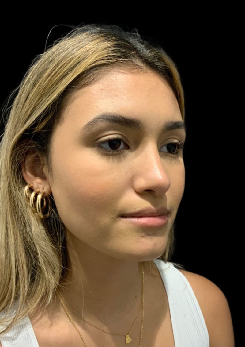Nose Before & After Gallery - Patient 189960712 - Image 6