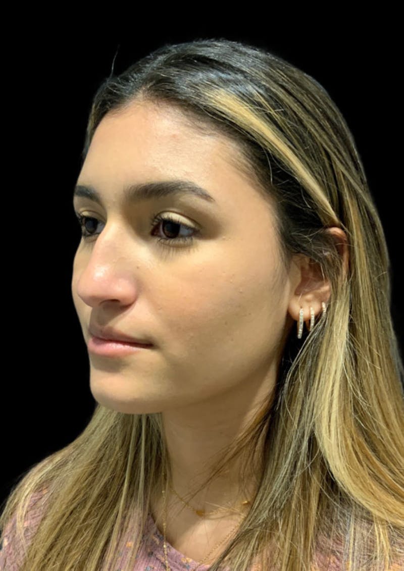 Nose Before & After Gallery - Patient 189960712 - Image 7