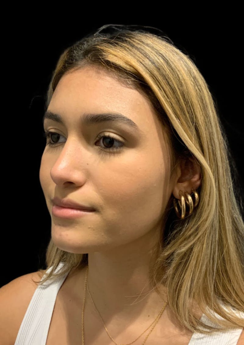 Nose Before & After Gallery - Patient 189960712 - Image 8