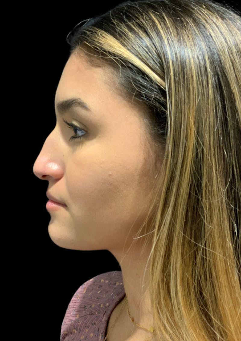 Nose Before & After Gallery - Patient 189960712 - Image 9