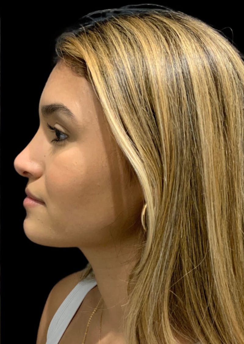 Nose Before & After Gallery - Patient 189960712 - Image 10