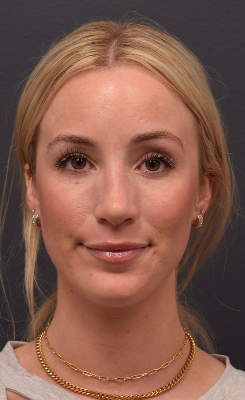 Nose Before & After Gallery - Patient 189960737 - Image 4