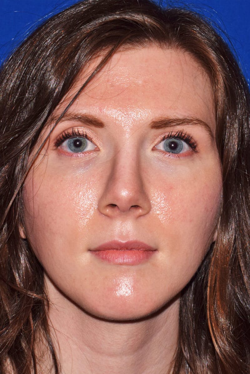 Nose Before & After Gallery - Patient 189960776 - Image 6