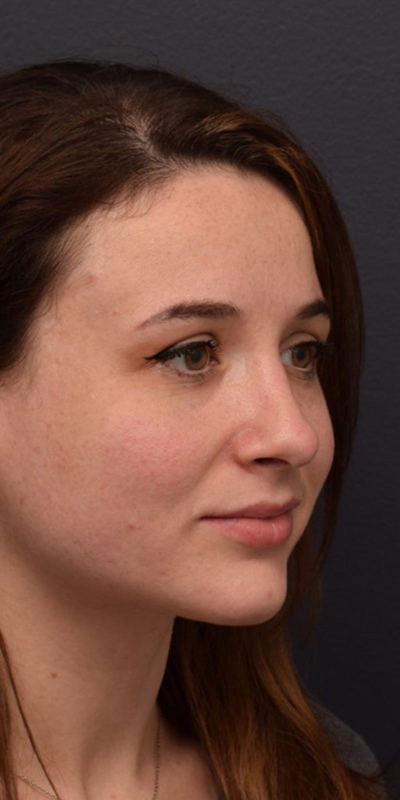 Nose Before & After Gallery - Patient 189960790 - Image 6