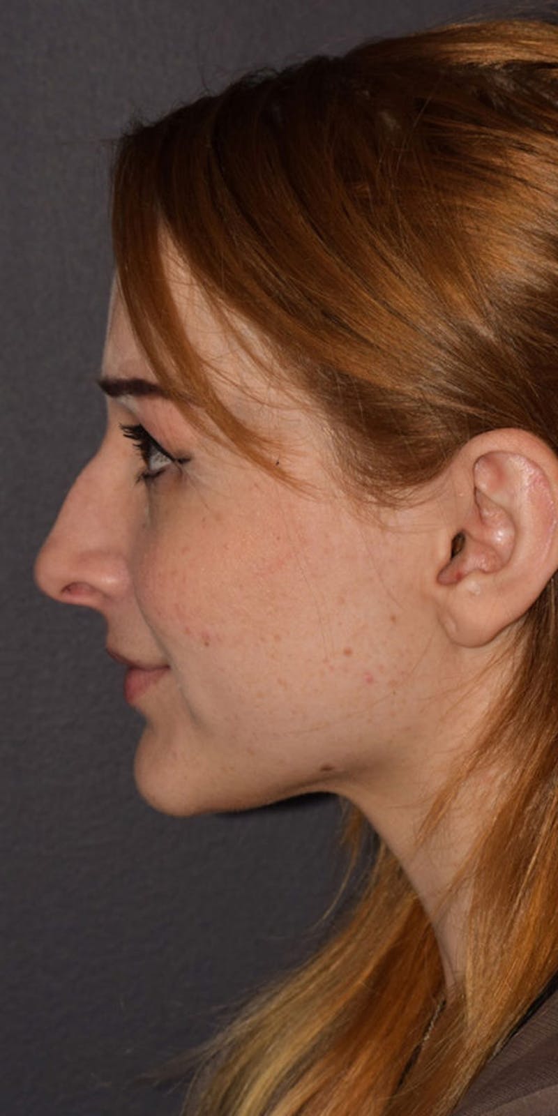 Nose Before & After Gallery - Patient 189960790 - Image 9